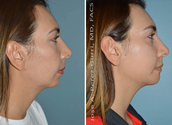 Before and after chin implant female patient right side