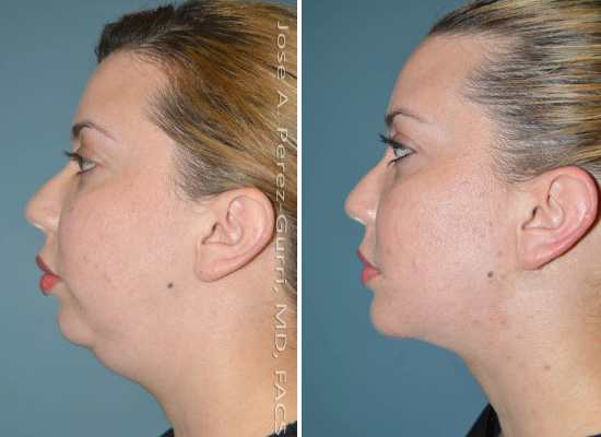 Before and after chin implant female patient left side
