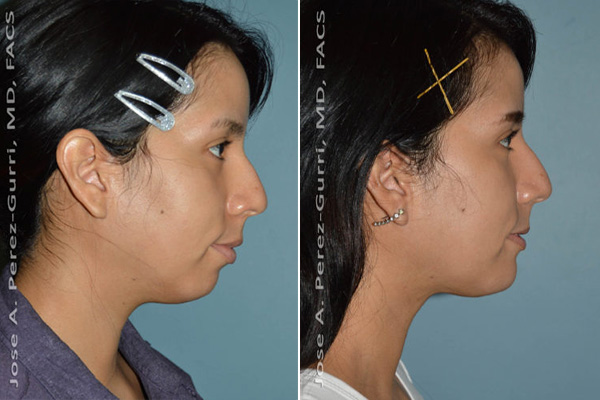 Before and after chin implant female patient right side