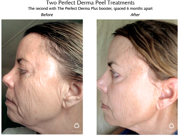 Before and after derma peel female patient left side