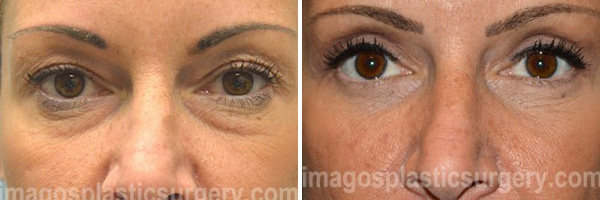 Before and after brow lift female patient Imagos Plastic Surgery