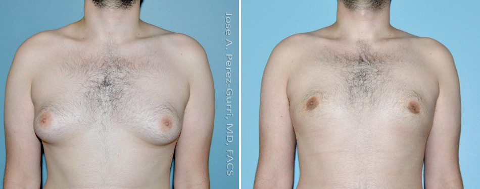 Before and after chin implant female patient right side