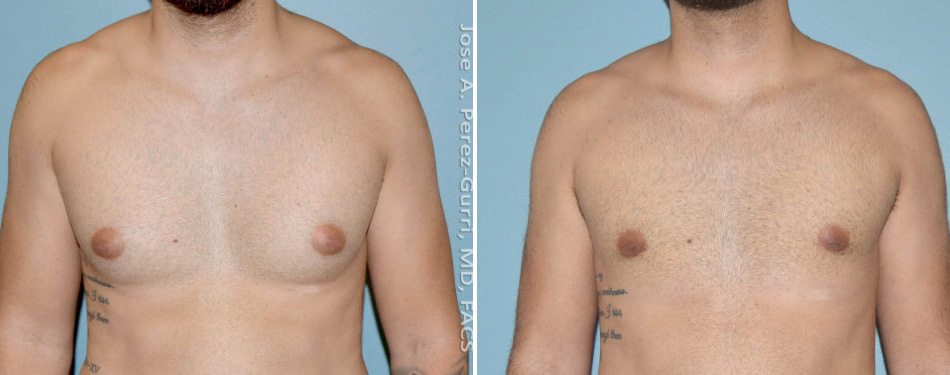 Before and after chin implant female patient right side