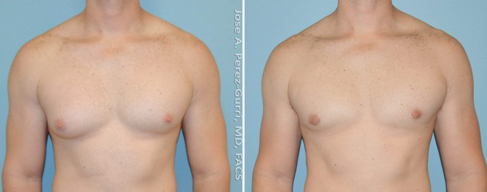 Before and after chin implant female patient right side