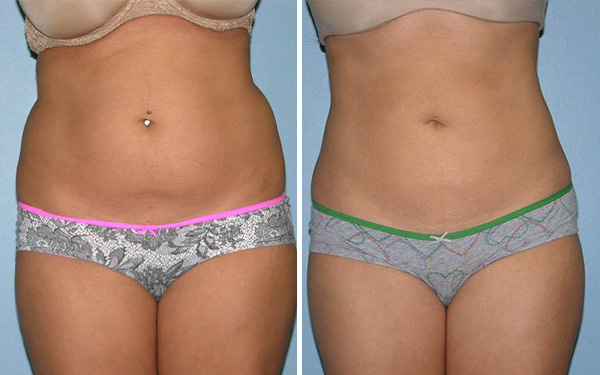 Before and after liposuction female patient Imagos Plastic Surgery