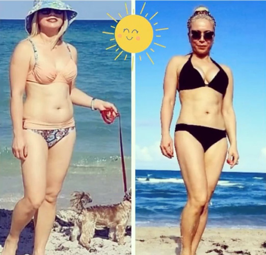 Before and after liposuction female patient Imagos Plastic Surgery