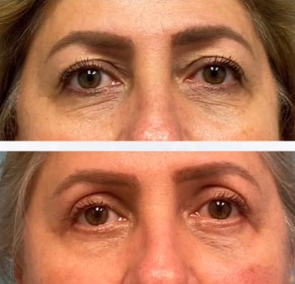 before and after blepharoplasty at Imagos Institute of Plastic Surgery in Miami, FL