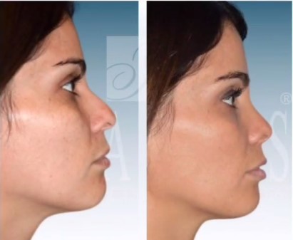 Before and after rhinoplasty female patient Imagos Plastic Surgery