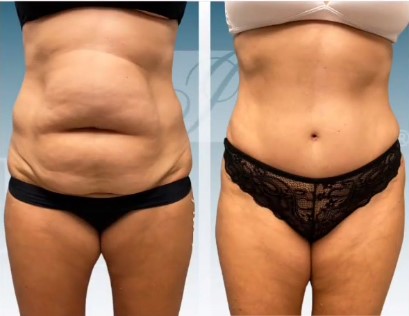 Before and after liposuction female patient Imagos Plastic Surgery