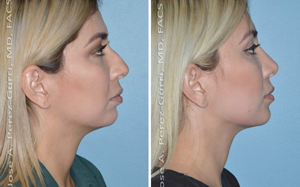 Before and after rhinoplasty female patient Imagos Plastic Surgery