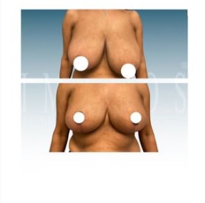 before and after front view of breast reduction at Imagos Institute of Plastic Surgery in Miami, FL