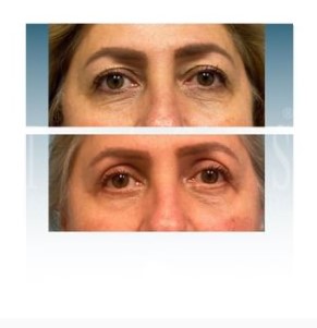 before and after front view of blepharoplasty at Imagos Institute of Plastic Surgery in Miami, FL