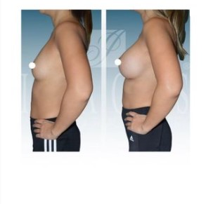 before and after left side view of breast surgery at Imagos Institute of Plastic Surgery in Miami, FL