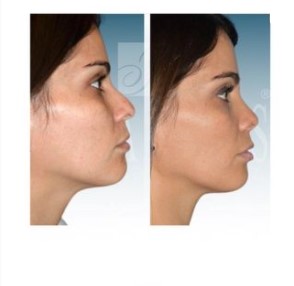 before and after right side view of rhinoplasty at Imagos Institute of Plastic Surgery in Miami, FL