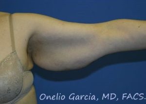 before closeup left arm lift female patient 2438