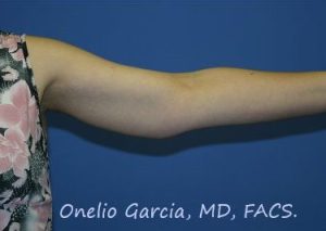 after closeup left arm lift female patient 2438