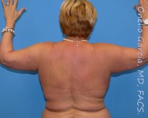 before back view arm lift of female patient 2445