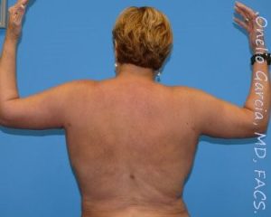 after back view arm lift of female patient 2445