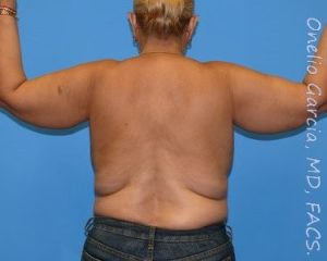 before back view arm lift of female patient 2452