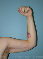 after front left arm view arm lift of female patient 2464
