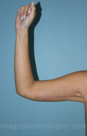 after front right arm view arm lift of female patient 2469