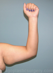 before front left arm view arm lift of female patient 2474