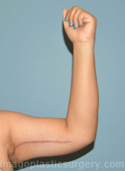 after front left arm view arm lift of female patient 2474