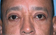 After eyelid surgery male patient front view case 4015