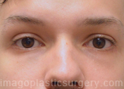 After eyelid surgery male patient front view case 4047