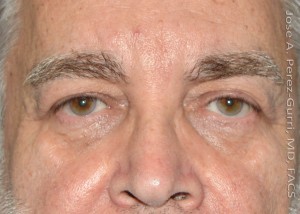 Before eyelid surgery male patient front view case 4055