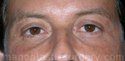 After eyelid surgery male patient front view case 4078