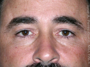 Before eyelid surgery male patient front view case 4098