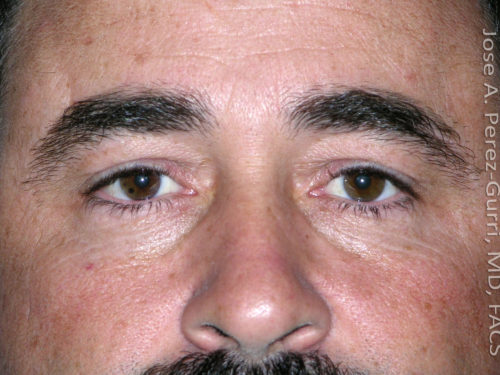 Before eyelid surgery male patient front view case 4098