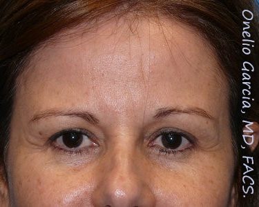 before front view botox of female patient 3182