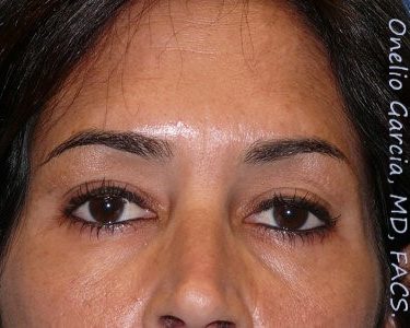 after front view botox of female patient 3190