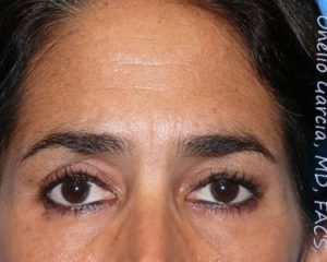 before front view botox of female patient 3190