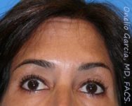 after brows up view botox of female patient 3190