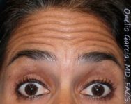 before brows up view botox of female patient 3190
