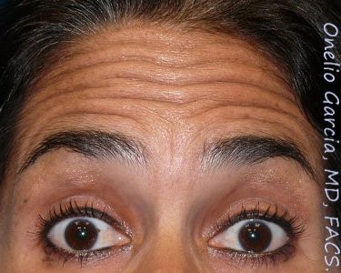 before brows up view botox of female patient 3190