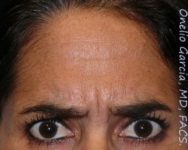 before brows down view botox of female patient 3190