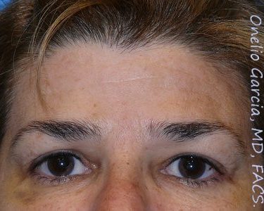after front view botox of female patient 3197