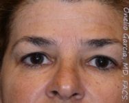 before front view botox of female patient 3197