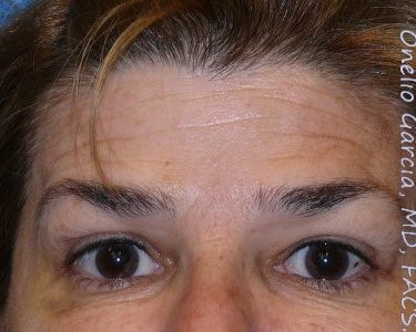 after brows up view botox of female patient 3197