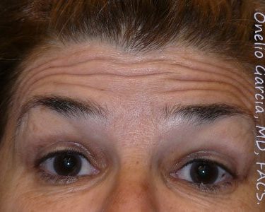 before brows up view botox of female patient 3197