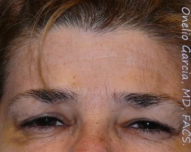 after brows down view botox of female patient 3197