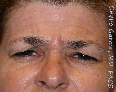 before brows down view botox of female patient 3197