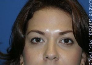 after front view botox of female patient 3204