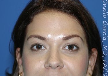 after front view botox of female patient 3204