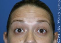 before brows up view botox of female patient 3204
