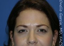 after brows down view botox of female patient 3204